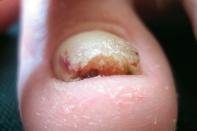 Applied aspects of nail 대표적인 손톱의 질환 알고 대비하자!! : 네이버 블로그