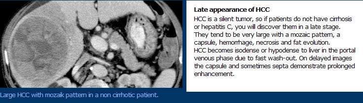 Mosaic Pattern Hcc | hcc liver dynamic ct 네이버 블로그 Mosaic Pattern Hcc | hcc liver dynamic ct 네이버 블로그