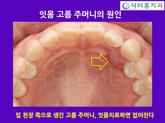 잇몸 고름주머니, 원인과 치료법 : 네이버 블로그