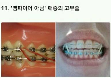 치아교정의 고통 ㄷㄷㄷ.jpg | 인스티즈
