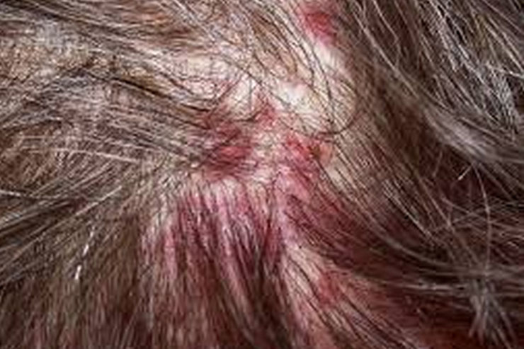 scalp-2-vrogue-co